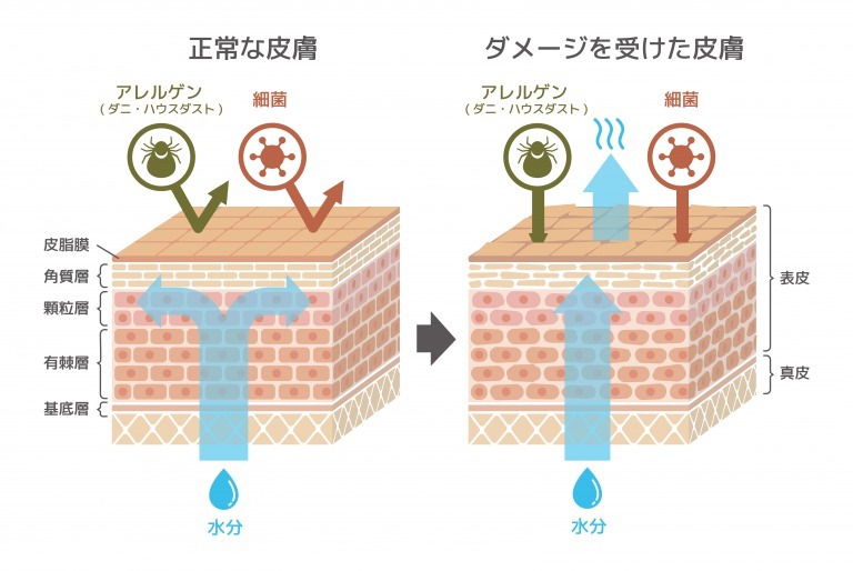 ダメージを受けた肌構造