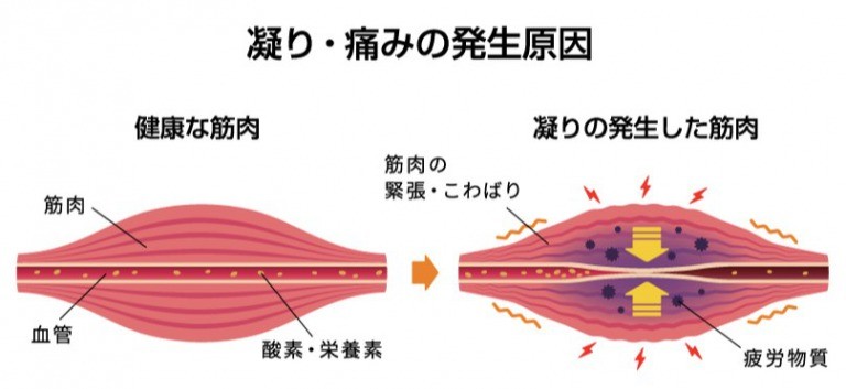 コリ・痛みの発生原因