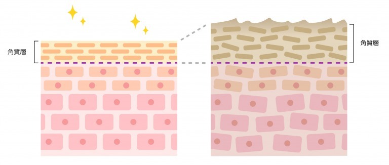 厚い角質層の図