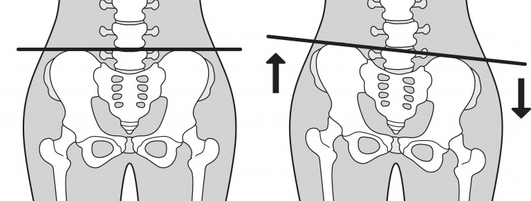 骨盤のゆがみ