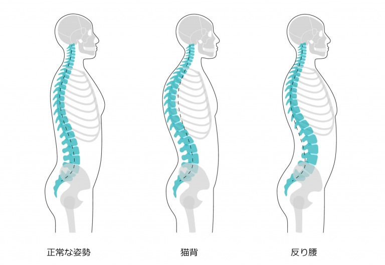 反り腰改善 