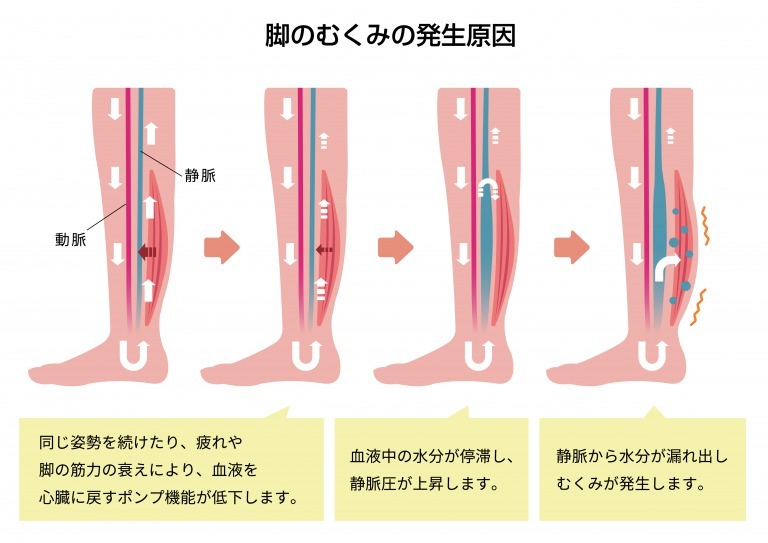 脚のむくみの発生原因