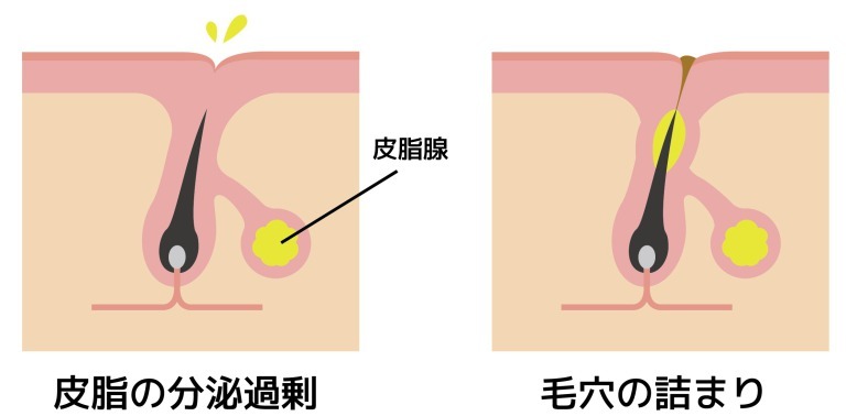 皮脂の過剰分泌と毛穴の詰まり