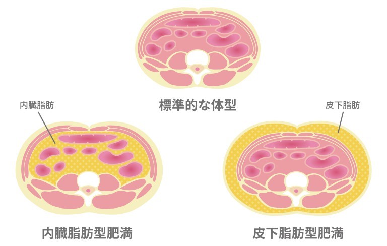 内臓脂肪型肥満と皮下脂肪型肥満