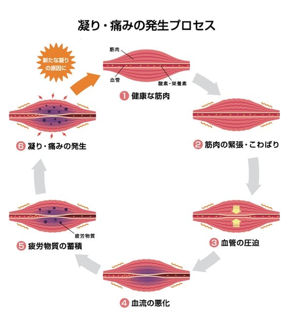 凝り・痛みの発生プロセス